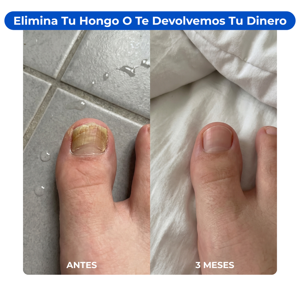 Gotas Antifúngicas HongOff
